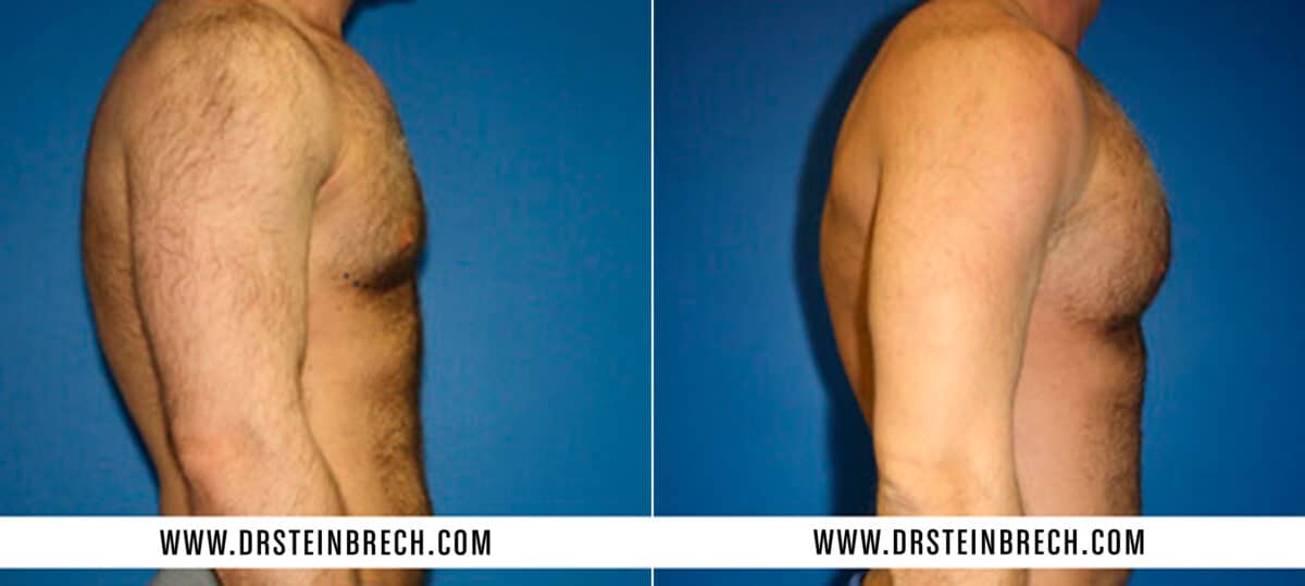 Pectoral Augmentation Before and After Photos in New York, NY, Patient 15546