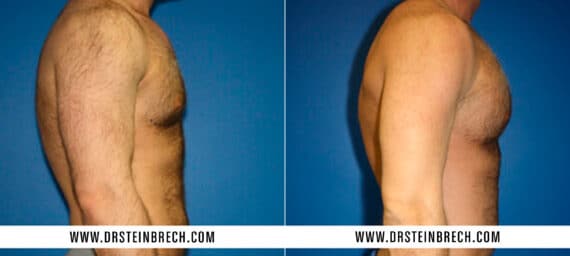 Pectoral Augmentation Before and After Photos in New York, NY, Patient 15546