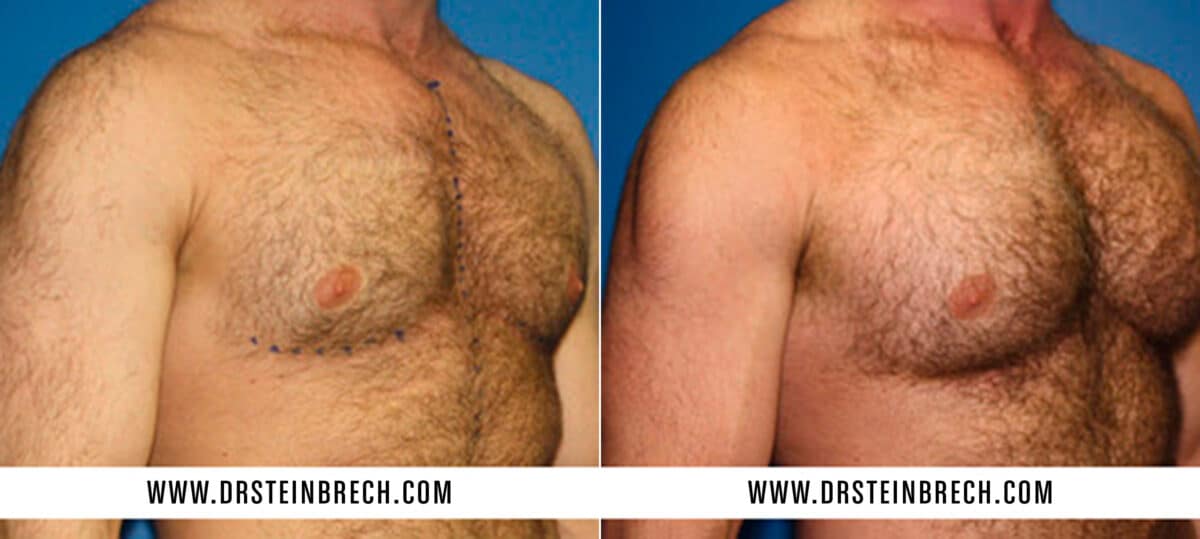 Pectoral Augmentation Before and After Photos in New York, NY, Patient 15546