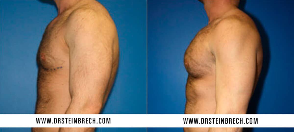 Pectoral Augmentation Before and After Photos in New York, NY, Patient 15546