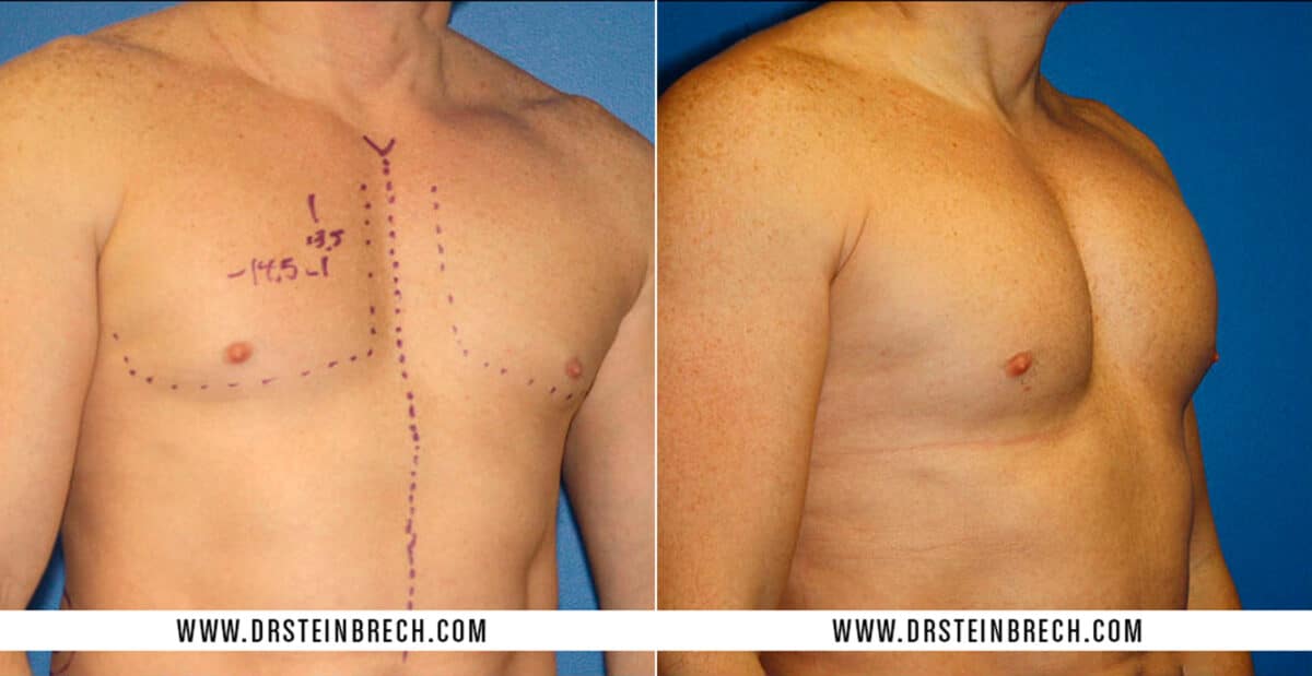Pectoral Augmentation Before and After Photos in New York, NY, Patient 15485