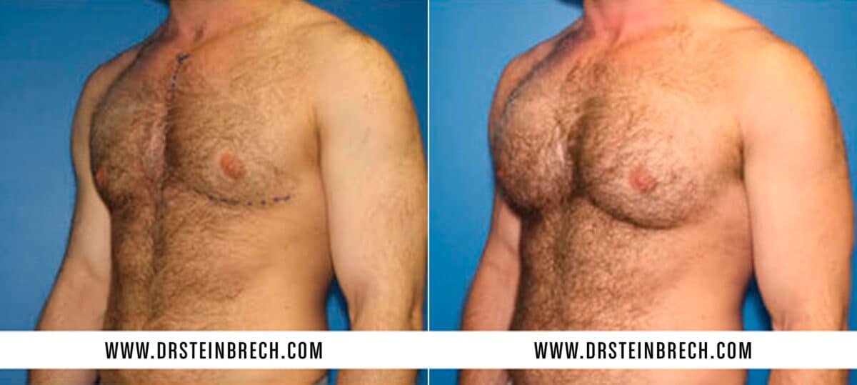 Pectoral Augmentation Before and After Photos in New York, NY, Patient 15546