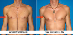 Pectoral Augmentation Before and After Photos in New York, NY, Patient 15564