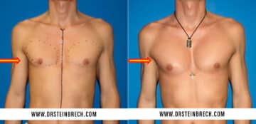 Pectoral Augmentation Before and After Photos in New York, NY, Patient 15564