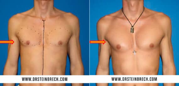 Pectoral Augmentation Before and After Photos in New York, NY, Patient 15564