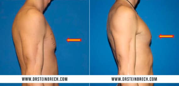 Pectoral Augmentation Before and After Photos in New York, NY, Patient 15564