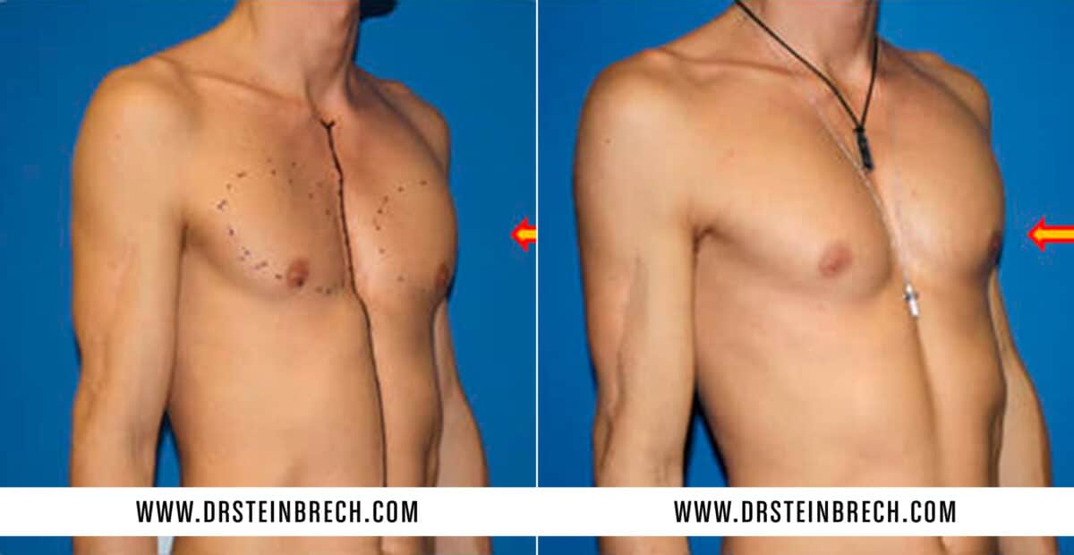 Pectoral Augmentation Before and After Photos in New York, NY, Patient 15564