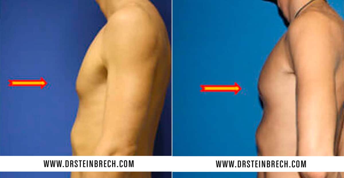 Pectoral Augmentation Before and After Photos in New York, NY, Patient 15564