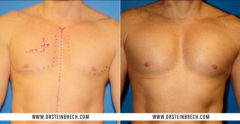 Pectoral Augmentation Before and After Photos in New York, NY, Patient 15485