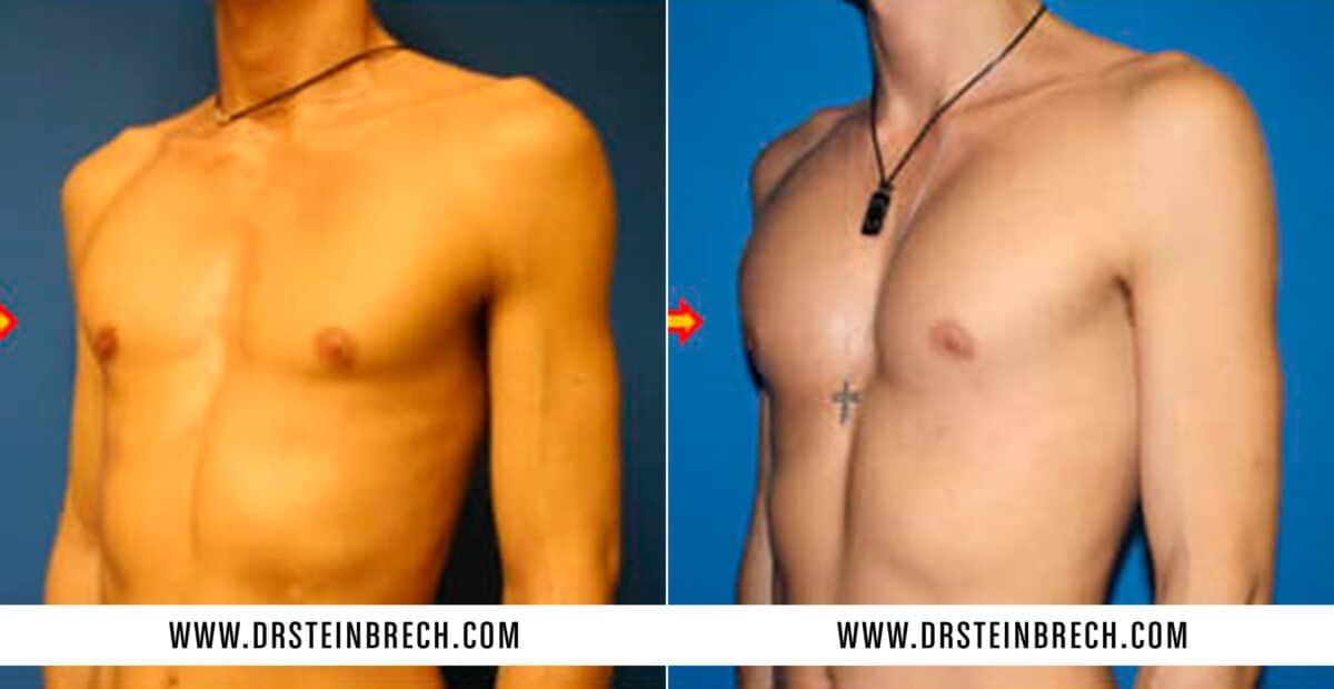 Pectoral Augmentation Before and After Photos in New York, NY, Patient 15564