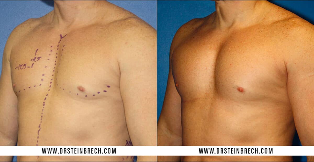 Pectoral Augmentation Before and After Photos in New York, NY, Patient 15485