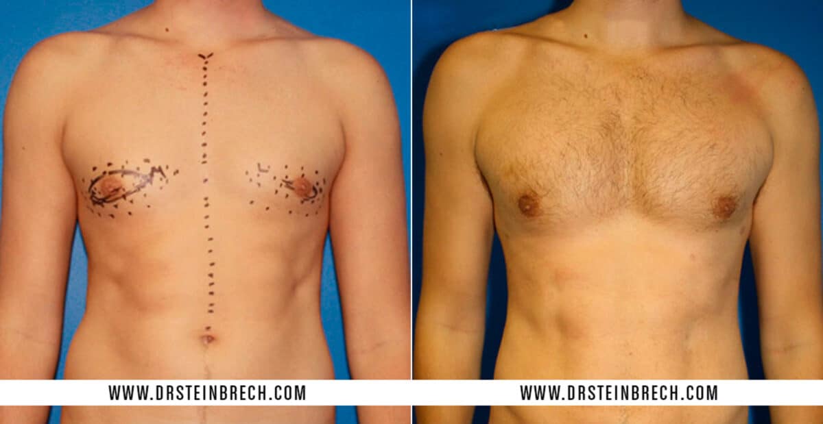 Pectoral Augmentation Before and After Photos in New York, NY, Patient 15499