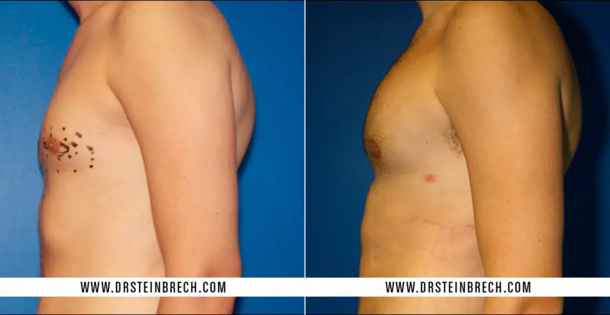 Pectoral Augmentation Before and After Photos in New York, NY, Patient 15499