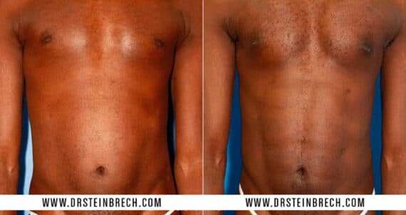 Pectoral Augmentation Before and After Photos in New York, NY, Patient 15507