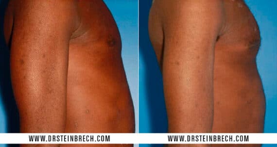 Pectoral Augmentation Before and After Photos in New York, NY, Patient 15507