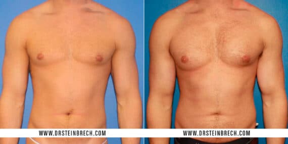 Pectoral Augmentation Before and After Photos in New York, NY, Patient 15516