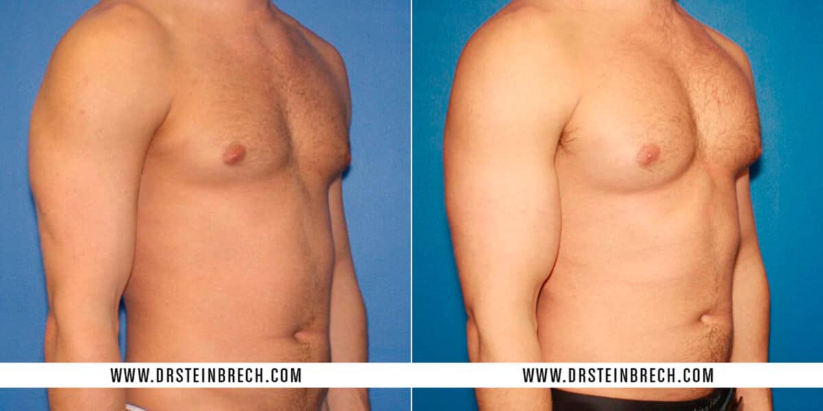 Pectoral Augmentation Before and After Photos in New York, NY, Patient 15516