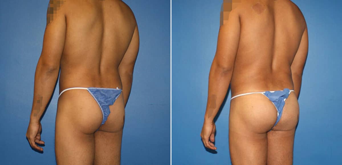 Body Banking Before and After Photos in New York, NY, Patient 16097