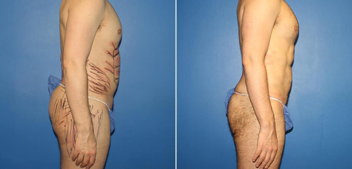 Body Banking Before and After Photos in New York, NY, Patient 16113