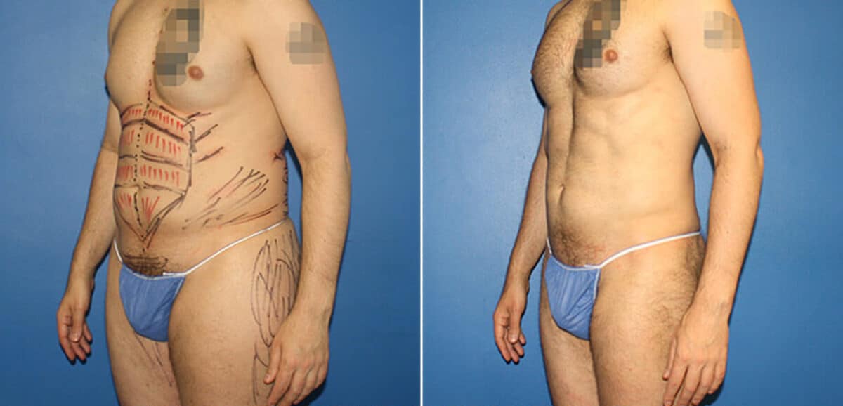 Body Banking Before and After Photos in New York, NY, Patient 16113