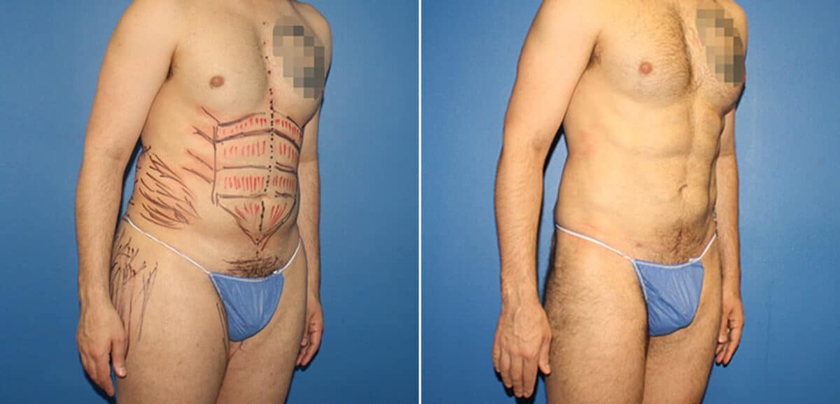 Body Banking Before and After Photos in New York, NY, Patient 16113