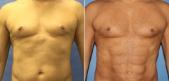 Body Banking Before and After Photos in New York, NY, Patient 16138