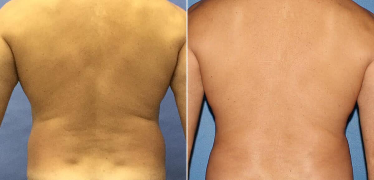 Body Banking Before and After Photos in New York, NY, Patient 16138