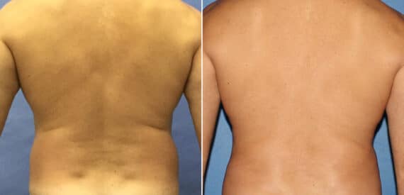 Body Banking Before and After Photos in New York, NY, Patient 16138