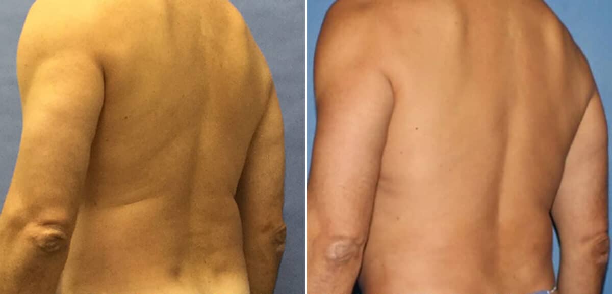 Body Banking Before and After Photos in New York, NY, Patient 16138