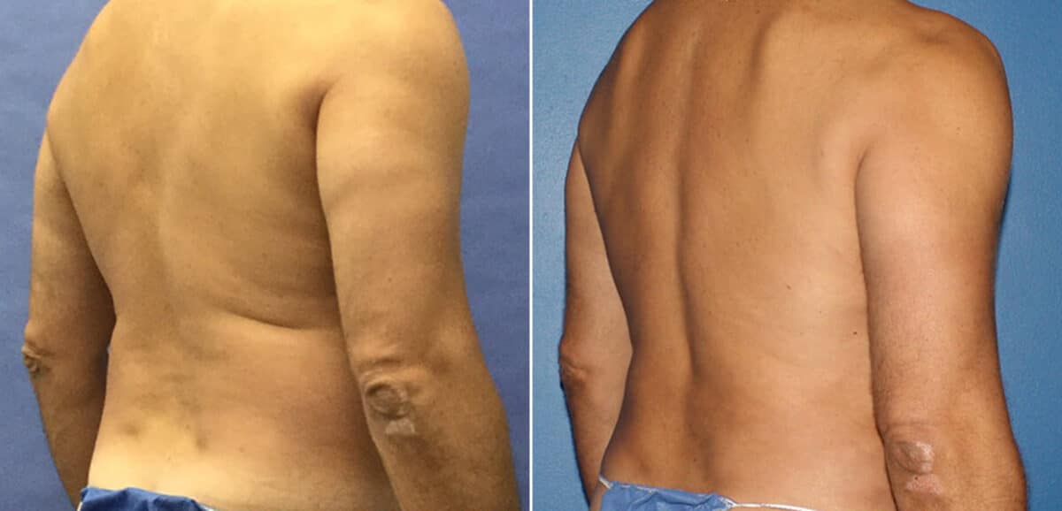 Body Banking Before and After Photos in New York, NY, Patient 16138