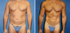 Body Banking Before and After Photos in New York, NY, Patient 16151