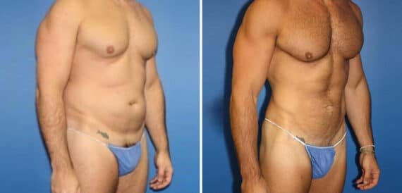 Body Banking Before and After Photos in New York, NY, Patient 16151