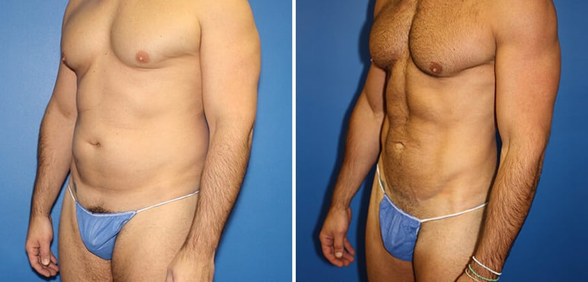 Body Banking Before and After Photos in New York, NY, Patient 16151