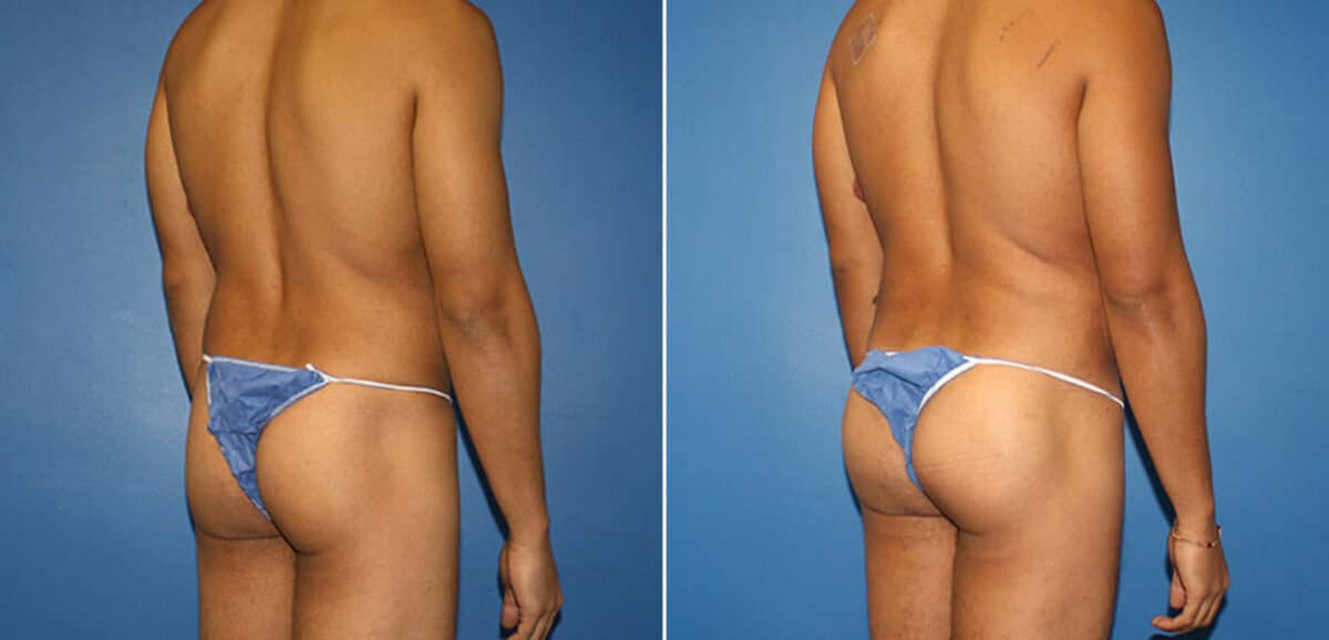 Body Banking Before and After Photos in New York, NY, Patient 16097