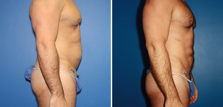 Body Banking Before and After Photos in New York, NY, Patient 16151