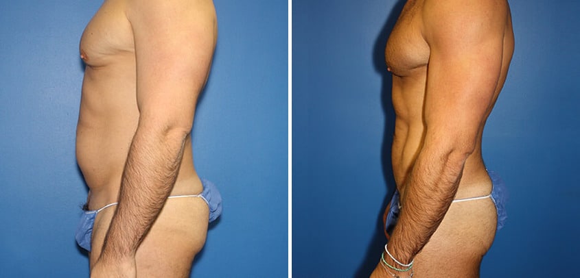 Body Banking Before and After Photos in New York, NY, Patient 16151