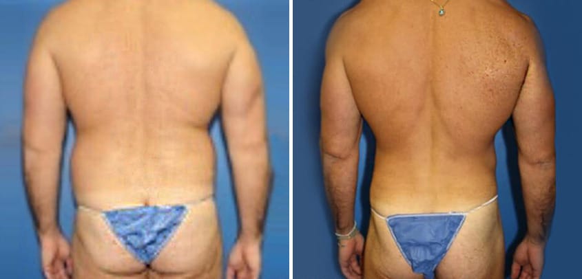 Body Banking Before and After Photos in New York, NY, Patient 16151