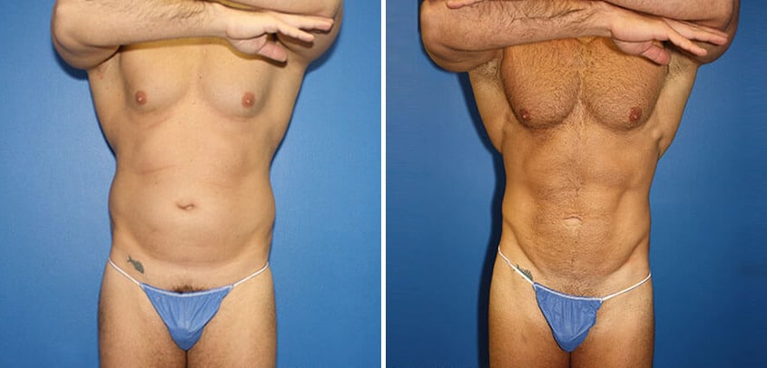Body Banking Before and After Photos in New York, NY, Patient 16151