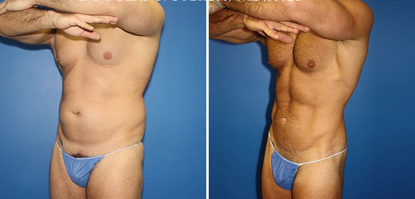 Body Banking Before and After Photos in New York, NY, Patient 16151