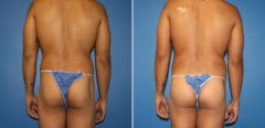 Body Banking Before and After Photos in New York, NY, Patient 16097