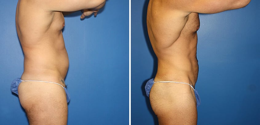 Body Banking Before and After Photos in New York, NY, Patient 16151
