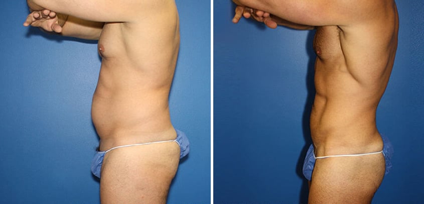 Body Banking Before and After Photos in New York, NY, Patient 16151