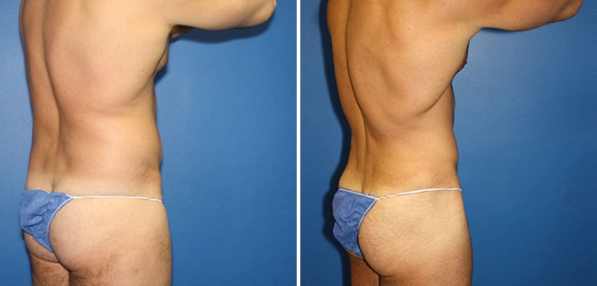 Body Banking Before and After Photos in New York, NY, Patient 16151
