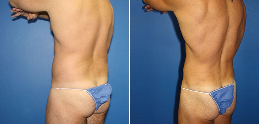 Body Banking Before and After Photos in New York, NY, Patient 16151