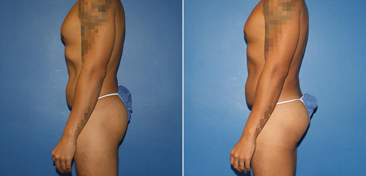 Body Banking Before and After Photos in New York, NY, Patient 16097