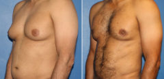 Body Banking Before and After Photos in New York, NY, Patient 16213