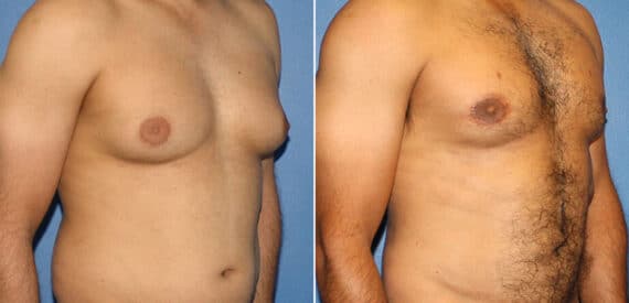 Body Banking Before and After Photos in New York, NY, Patient 16213