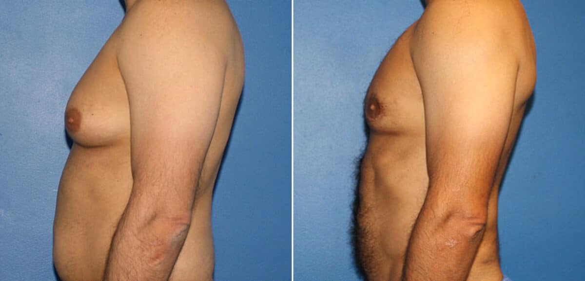 Body Banking Before and After Photos in New York, NY, Patient 16213