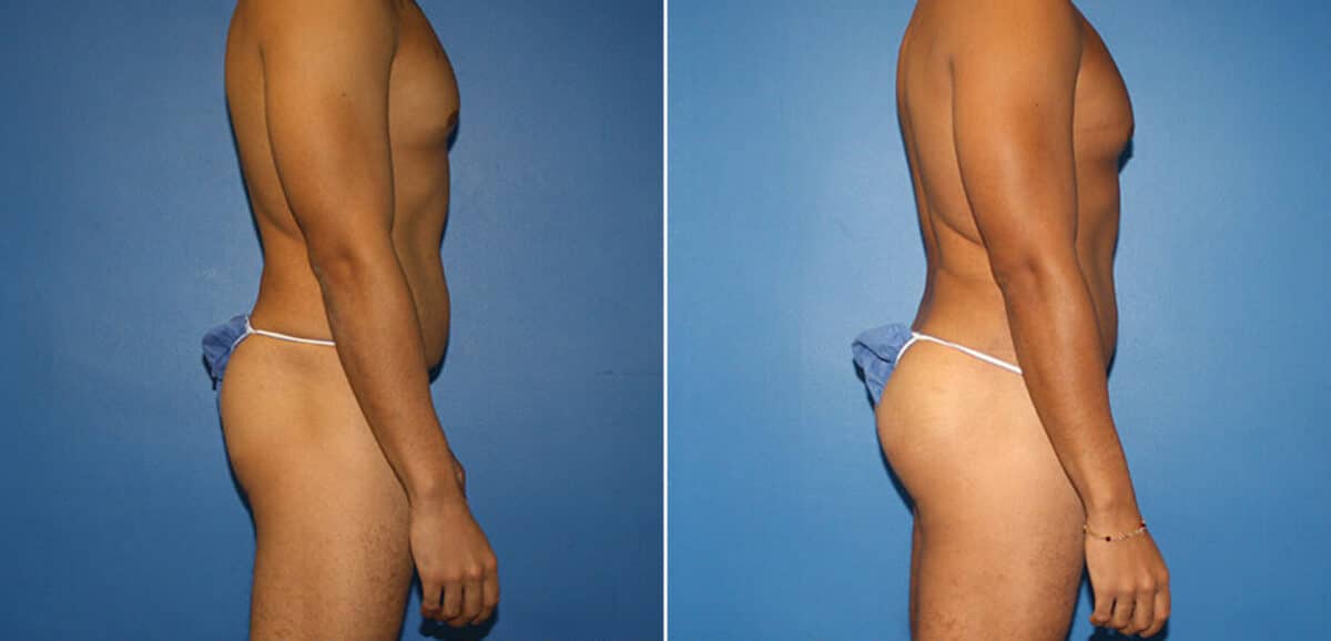 Body Banking Before and After Photos in New York, NY, Patient 16097