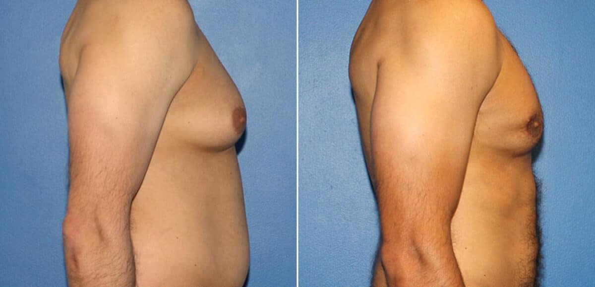 Body Banking Before and After Photos in New York, NY, Patient 16213